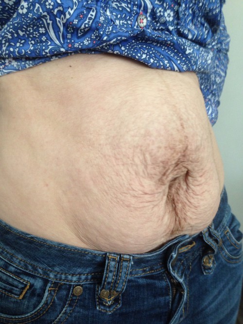 deformacja brzucha po ciąży
